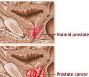 LIVING WITH PROSTATE CANCER